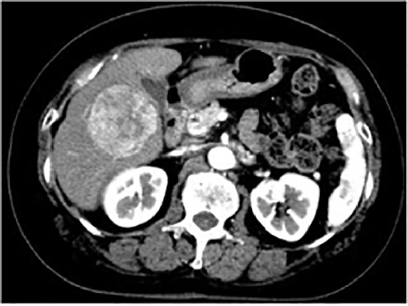 肝细胞癌病例CT图像（首发例）