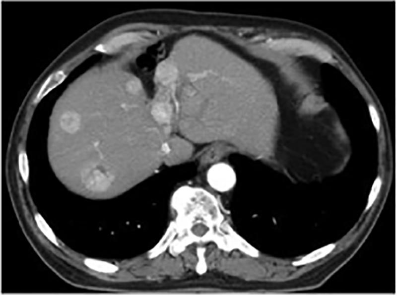 肝细胞癌病例CT图像（多发例）