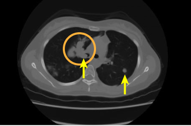 肝细胞癌病例CT图像（肺转移例）