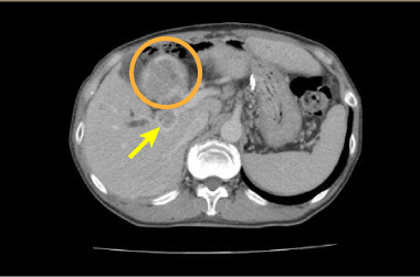 肝细胞癌病例CT图像（门脉浸润型）