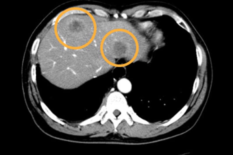 肺癌肝转移例